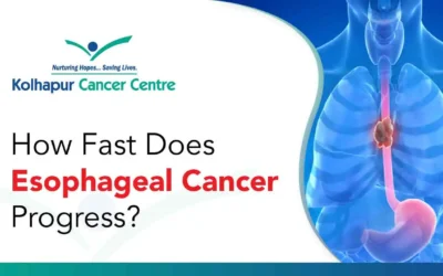 Does Esophageal Cancer Spread Quickly?