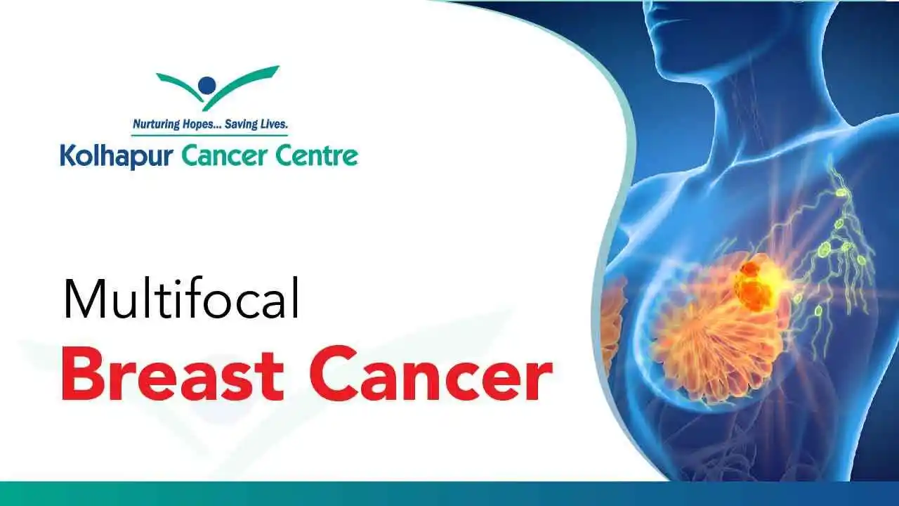 Multifocal Breast Cancer