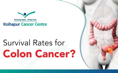 What Is the Survival Rate for Colon Cancer?