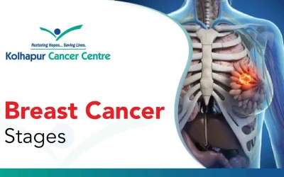 The Stages of Breast Cancer: A Comprehensive Guide for Patients