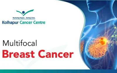 What Is Multifocal Breast Cancer? A Comprehensive Guide