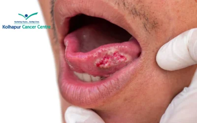 Oral Cancer Survival Rates