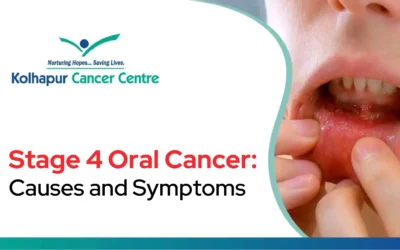 Stage 4 Oral Cancer: Causes and Symptoms