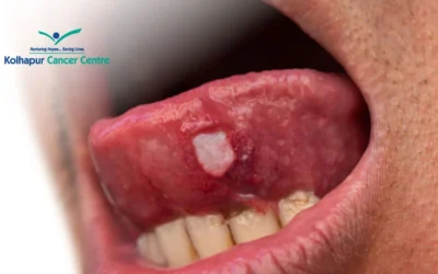 How Tongue Cancer Look Like?
