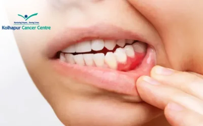 Untreated Oral Cancer Survival Rates by Stage